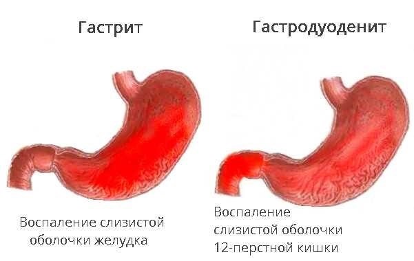 Почему людей с тяжелыми проблемами пищеварения не берут в армию