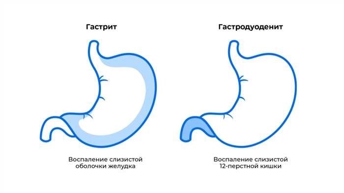 С какими болезнями органов пищеварения не берут в армию